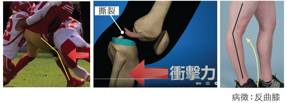 PCL Hyper-Extension Mechanism